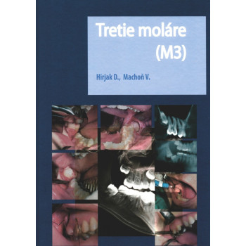 Tretie moláre (M3)