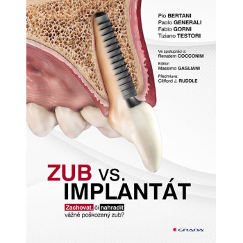 Zub vs. Implantát - Zachovat, či nahradiť vážne poškozený zub?