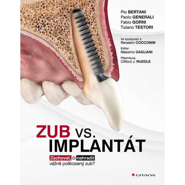 Zub vs. Implantát - Zachovat, či nahradiť vážne poškozený zub?