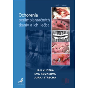 Ochorenia periimplantačných tkanív a ich liečba
