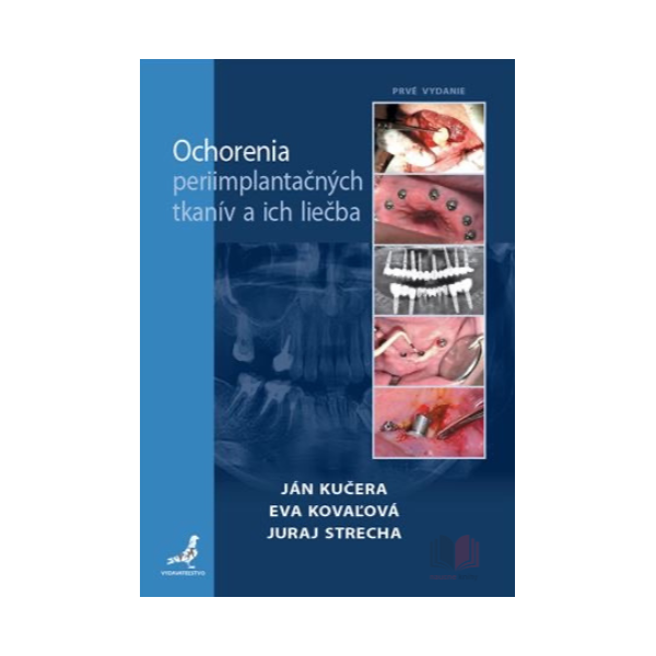 Ochorenia periimplantačných tkanív a ich liečba
